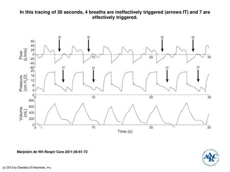 In this tracing of 30 seconds, 4 breaths are ineffectively triggered (arrows IT) and 7 are effectively triggered. In this tracing of 30 seconds, 4 breaths.