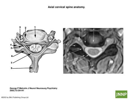 Axial cervical spine anatomy.