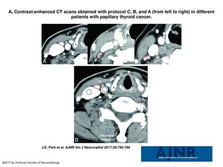 A, Contrast-enhanced CT scans obtained with protocol C, B, and A (from left to right) in different patients with papillary thyroid cancer. A, Contrast-enhanced.