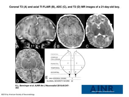 Coronal T2 (A) and axial TI FLAIR (B), ADC (C), and T2 (D) MR images of a 21-day-old boy. Coronal T2 (A) and axial TI FLAIR (B), ADC (C), and T2 (D) MR.