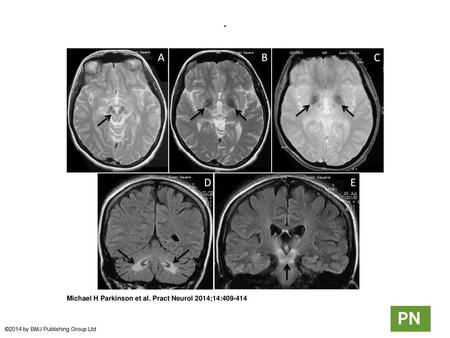 . . MR scan of brain (1.5 Tesla), patient aged 30 years. (A) Axial T2-weighted sequences at midbrain level show disproportionate volume loss and signal.