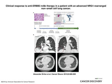 Clinical response to anti-ERBB3 mAb therapy in a patient with an advanced NRG1-rearranged non–small cell lung cancer. Clinical response to anti-ERBB3 mAb.