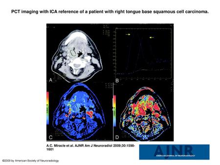 PCT imaging with ICA reference of a patient with right tongue base squamous cell carcinoma. PCT imaging with ICA reference of a patient with right tongue.