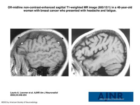 Off-midline non-contrast-enhanced sagittal T1-weighted MR image (600/12/1) in a 48-year-old woman with breast cancer who presented with headache and fatigue.