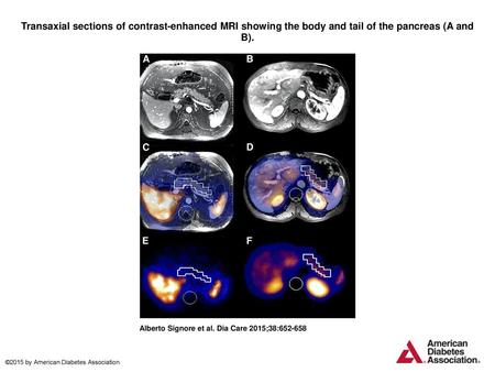 Transaxial sections of contrast-enhanced MRI showing the body and tail of the pancreas (A and B). Transaxial sections of contrast-enhanced MRI showing.