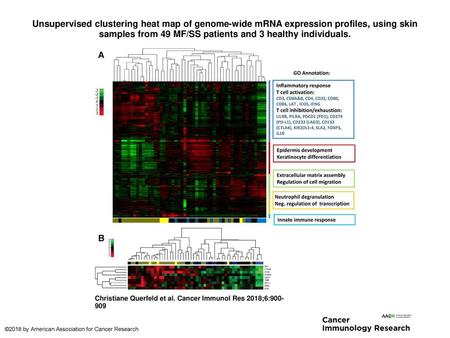 Unsupervised clustering heat map of genome-wide mRNA expression profiles, using skin samples from 49 MF/SS patients and 3 healthy individuals. Unsupervised.