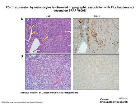 PD-L1 expression by melanocytes is observed in geographic association with TILs but does not depend on BRAF V600E. PD-L1 expression by melanocytes is observed.