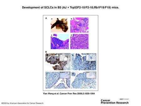 Development of SCLCs in B5 (AJ × Trp53F2-10/F2-10;Rb1F19/F19) mice.