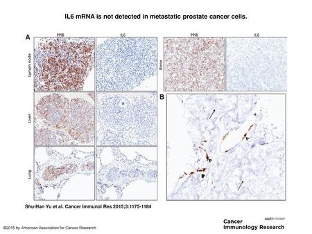 IL6 mRNA is not detected in metastatic prostate cancer cells.