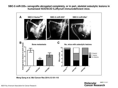 SBC-5 miR-335+ xenografts abrogated completely, or in part, skeletal osteolytic lesions in humanized NOD/SCID IL2Rγnull immunodeficient mice. SBC-5 miR-335+