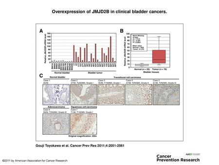 Overexpression of JMJD2B in clinical bladder cancers.