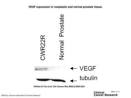 VEGF expression in neoplastic and normal prostate tissue.