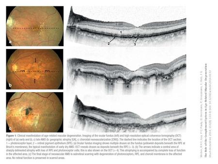 Weber, B H F; Issa, P C; Pauly, D; Herrmann, P; Grassmann, F; Holz, F G The Role of the Complement System in Age-Related Macular Degeneration Dtsch Arztebl.