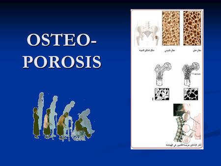 OSTEO- POROSIS. OSTEO- POROSIS Dr.Abdullah Al-Omran.