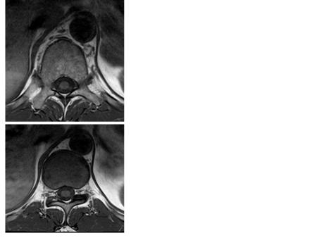 MRI of the Thoracic Spine: Axial T1 wtd.images.