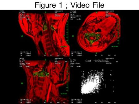 Figure 1 ； Video File. Figure 2 : Anatomical orthogonal coordinate system Z Y +RY ： Left Axial Rotation -RY: Right Axial Rotation +RZ ： Right Lateral.