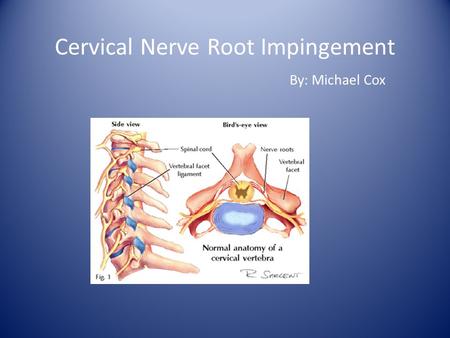 Cervical Nerve Root Impingement By: Michael Cox