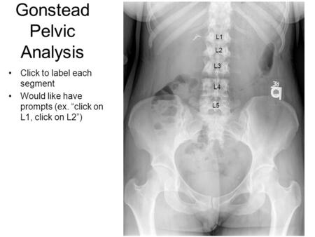 Gonstead Pelvic Analysis