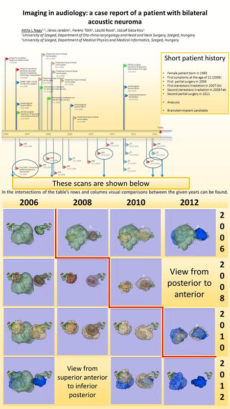 Imaging in audiology: a case report of a patient with bilateral acoustic neuroma Attila L Nagy 1,5, János Jarabin 1, Ferenc Tóth 1, László Rovó 1, József.