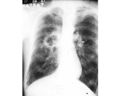 Large cell carcinoma Accounts for 5-10% of all lung cancers.