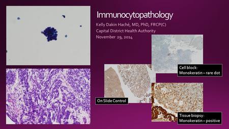 Cell block: Monokeratin – rare dot Tissue biopsy: Monokeratin – positive On Slide Control.