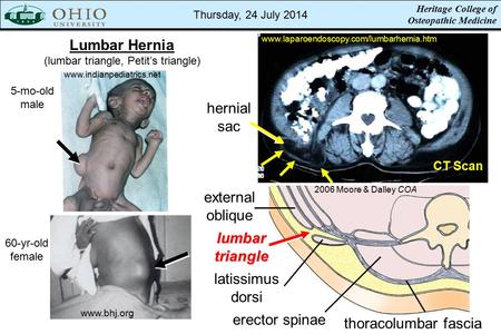 Heritage College of Osteopathic Medicine www.laparoendoscopy.com/lumbarhernia.htm 2006 Moore & Dalley COA lumbartriangle latissimus dorsi external oblique.