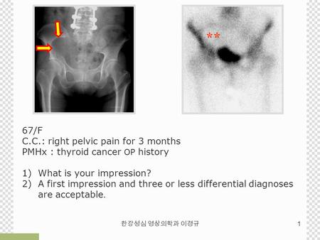 ** 67/F C.C.: right pelvic pain for 3 months