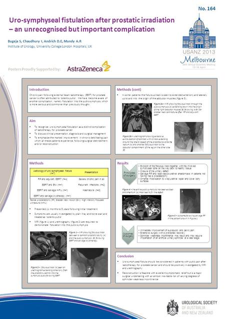 Uro-symphyseal fistulation after prostatic irradiation – an unrecognised but important complication Introduction Chronic pain following external beam radiotherapy.