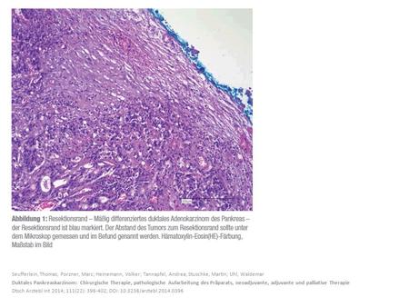Seufferlein, Thomas; Porzner, Marc; Heinemann, Volker; Tannapfel, Andrea; Stuschke, Martin; Uhl, Waldemar Duktales Pankreaskarzinom: Chirurgische Therapie,