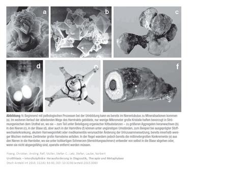 Fisang, Christian; Anding, Ralf; Müller, Stefan C.; Latz, Stefan; Laube, Norbert Urolithiasis – interdisziplinäre Herausforderung in Diagnostik, Therapie.