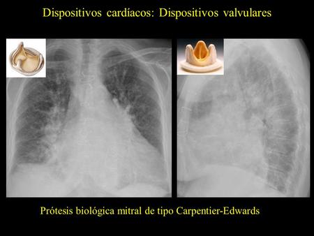 Dispositivos cardíacos: Dispositivos valvulares Prótesis biológica mitral de tipo Carpentier-Edwards.