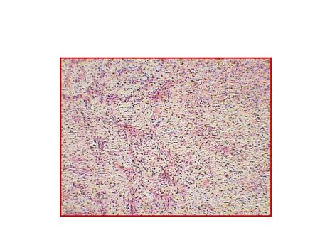 Periapical Granuloma Chronic inflammatory reaction in response to a pulpal infection with bacteria. All we can see here are tiny blue dots sprinkled.