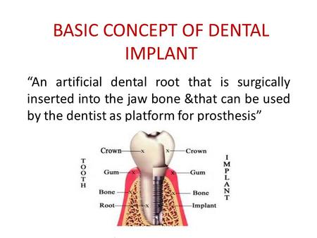 BASIC CONCEPT OF DENTAL IMPLANT “An artificial dental root that is surgically inserted into the jaw bone &that can be used by the dentist as platform for.