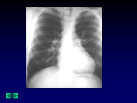 Diagnosis : Coarctation of the Aorta