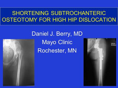 SHORTENING SUBTROCHANTERIC OSTEOTOMY FOR HIGH HIP DISLOCATION