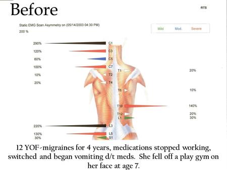 Before 12 YOF-migraines for 4 years, medications stopped working, switched and began vomiting d/t meds. She fell off a play gym on her face at age 7.