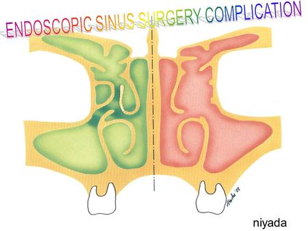 Niyada. Prevention Avoid dangerous cases : revision, massive diseases, bleeding tendency Pre op. CT scan, CT aid ESS Pre op. preparation Intra op. observation.