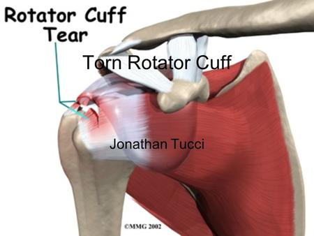 Torn Rotator Cuff Jonathan Tucci. What is a torn rotator cuff? A rotator cuff tear is when one of the four major tendons that make up the rotator cuff.