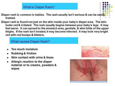 What is Diaper Rash? Diaper rash is common in babies. The rash usually isn’t serious & can be easily treated. Diaper rash is found not just on the skin.