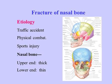 Fracture of nasal bone Etiology Traffic accident Physical combat. Sports injury Nasal bone--- Upper end: thick Lower end: thin.