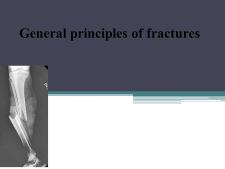 General principles of fractures. A fracture is a break in the structural continuity of bone. It my be no more than a crack, a crumpling or a splintering.