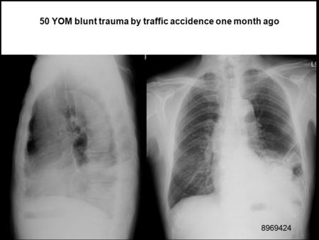 8969424 50 YOM blunt trauma by traffic accidence one month ago.