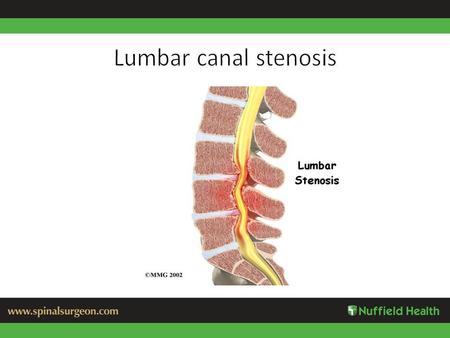 Causes of Stenosis Degenerative spondylo-listhesis Facet subluxation and hypertrophy Pagets disease Tumour Facet joint cyst Congenital- achondroplasia.