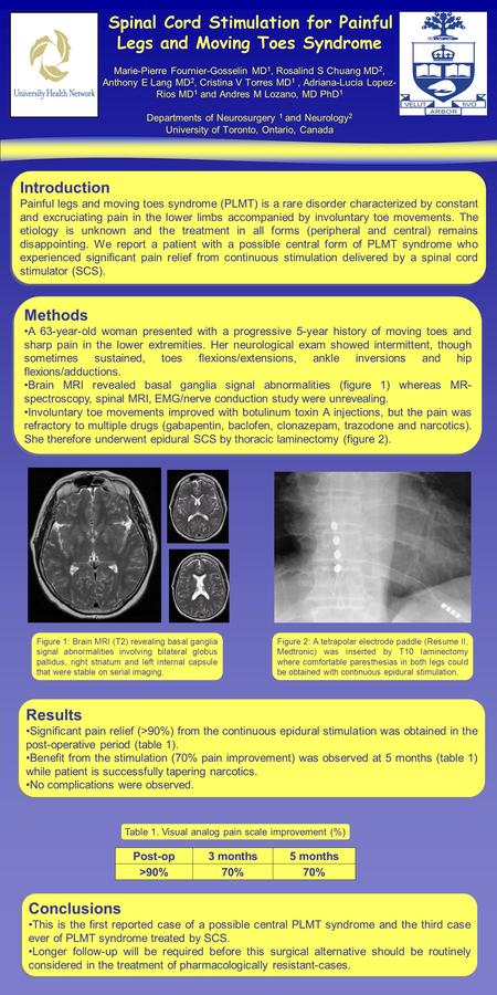 Spinal Cord Stimulation for Painful Legs and Moving Toes Syndrome Marie-Pierre Fournier-Gosselin MD 1, Rosalind S Chuang MD 2, Anthony E Lang MD 2, Cristina.