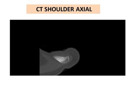 CT SHOULDER AXIAL.