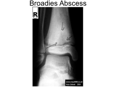 Broadies Abscess. Clalcaneal spur Calcaneal Fracture.