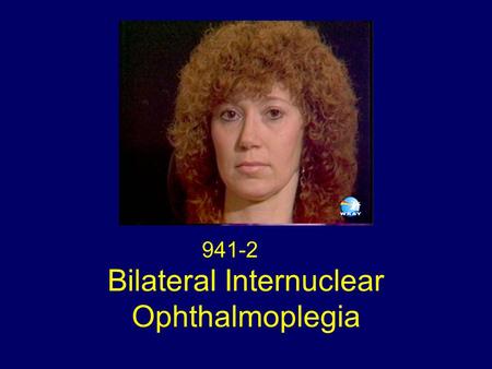 Bilateral Internuclear Ophthalmoplegia 941-2. Eye Movements Bilateral Internuclear Ophthalmoplegia Acquired Pendular Nystagmus Lid Nystagmus Upbeat Nystagmus.