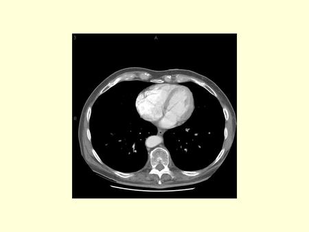 IVC What is this contrast containing structure posterior to the liver? The right, middle and left hepatic veins What are these contrast containing.