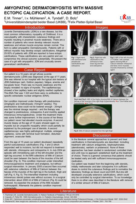 AMYOPATHIC DERMATOMYOSITIS WITH MASSIVE ECTOPIC CALCIFICATION. A CASE REPORT. E.M. Tinner 1, I.v. Mühlenen 2, A. Tyndall 2, D. Bolz 1 1 Universitätskinderspital.