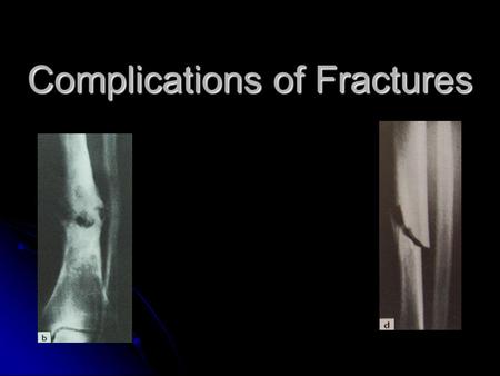 Complications of Fractures